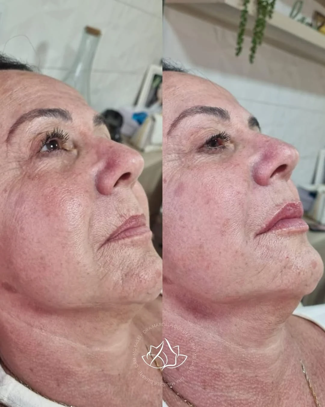 Preenchimento labial com técnica e respeito à anatomia