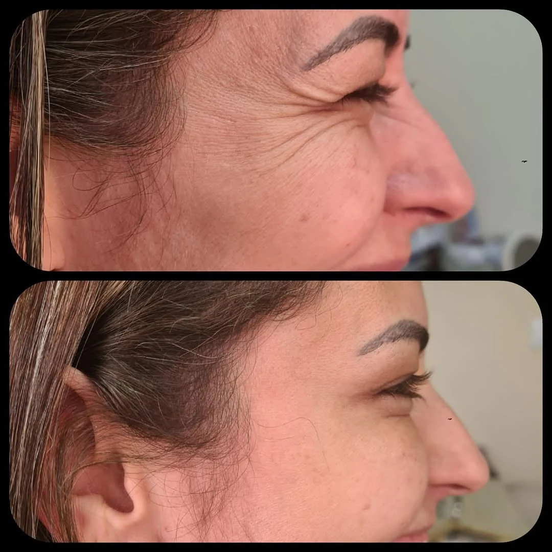 Pé de galinha suavizado com Botox