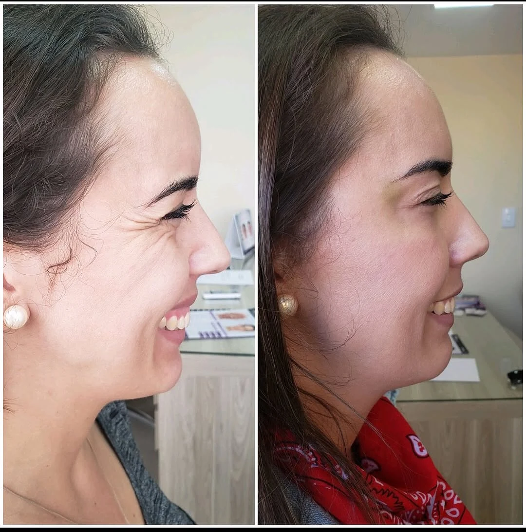 Botox que rejuvenesce sem perder a naturalidade